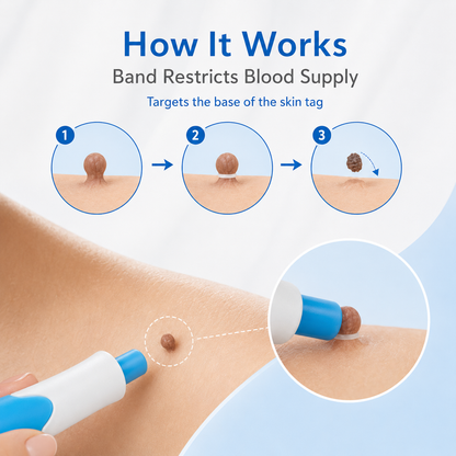 🩹 2-in-1 Auto Band Skin Tag Removal Kit – Dual Size Home Applicator ✨