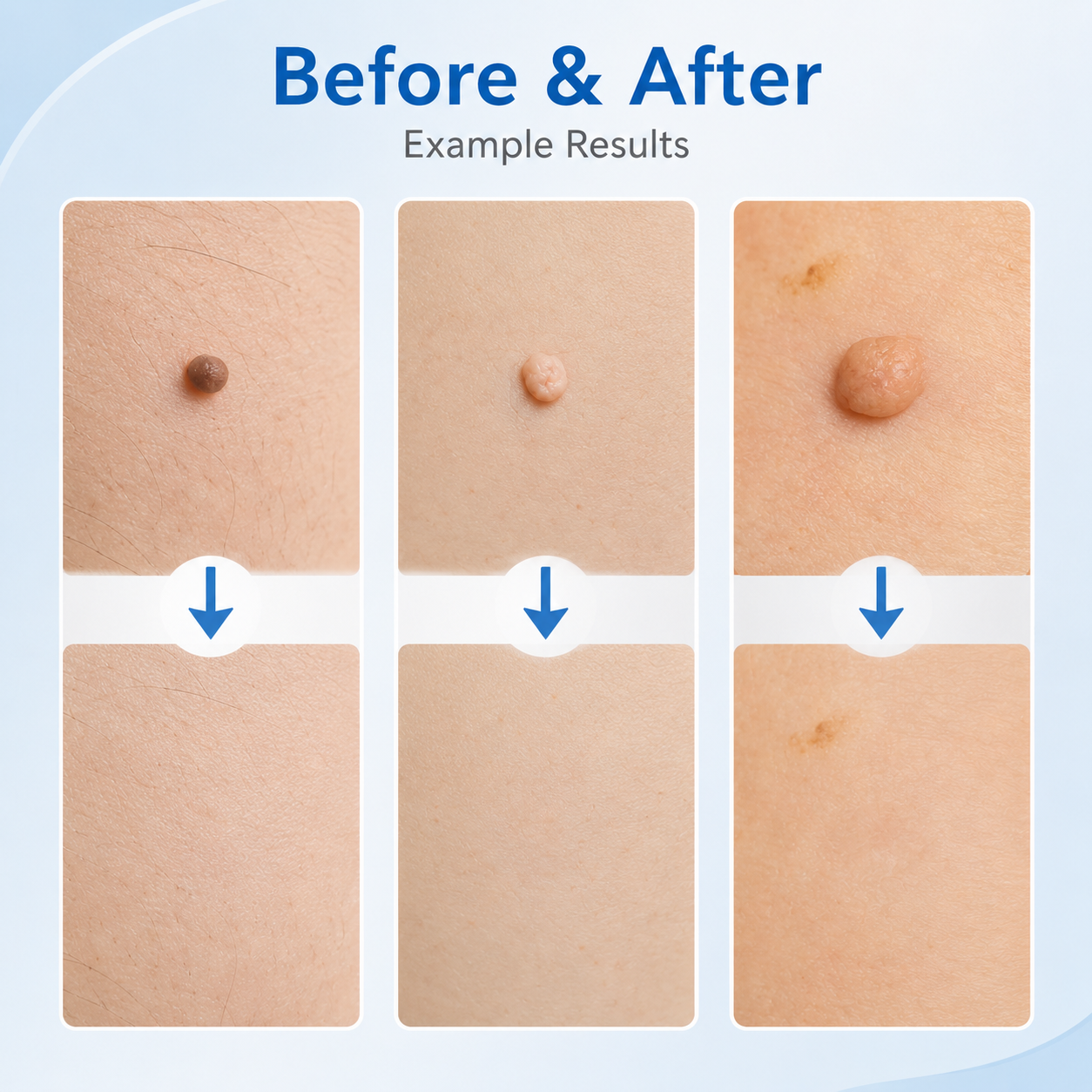 🩹 2-in-1 Auto Band Skin Tag Removal Kit – Dual Size Home Applicator ✨