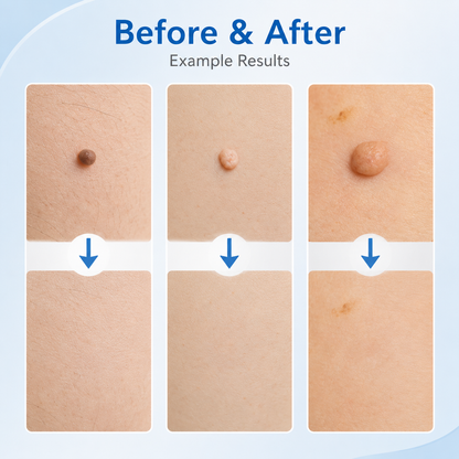 🩹 2-in-1 Auto Band Skin Tag Removal Kit – Dual Size Home Applicator ✨
