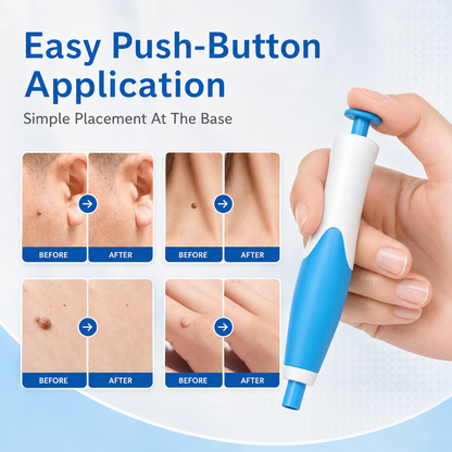 🩹 2-in-1 Auto Band Skin Tag Removal Kit – Dual Size Home Applicator ✨