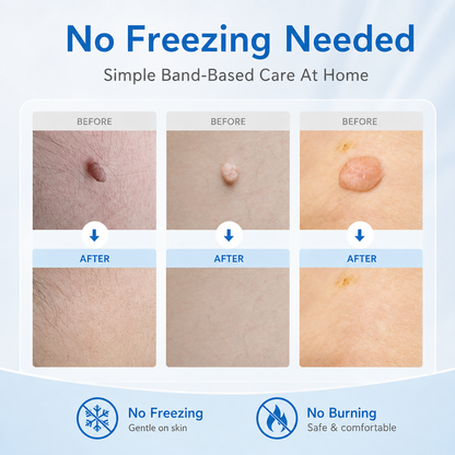 🩹 2-in-1 Auto Band Skin Tag Removal Kit – Dual Size Home Applicator ✨